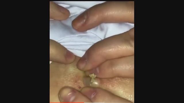 Новое! Выдавливание прыщей # Удаление черных точек 2021 # Прыщи выдавливание # Черная маска смотреть онлайн