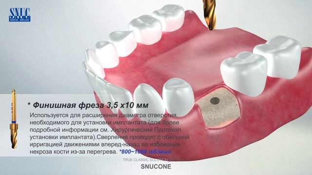 SNUCONE Dental Implant смотреть онлайн