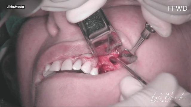 Sinus Lift / Maxillary Sinus Augmentation смотреть онлайн