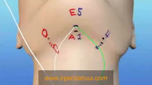 Neck lift surgery in Iran смотреть онлайн