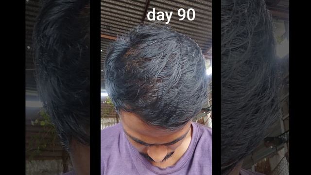 Minoxidil 5% using 8 month hair growth results смотреть онлайн