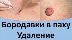 Бородавки в паху удаление.