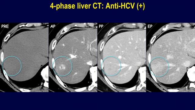 Why this liver lesion might have been missed on ultrasonography? смотреть онлайн