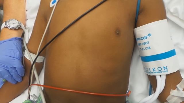 Kussmaul Breathing Pattern