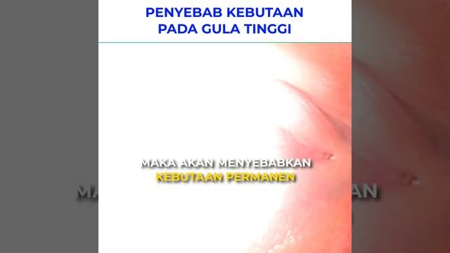 Penyebab Kebutaan Pada Gula Tinggi смотреть онлайн