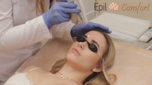 02. Лазерная эпиляция области Бровей