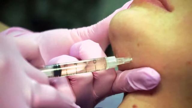 Как устранить  «второй подбородок»? Советы профессионального врача- дерматокосметолога