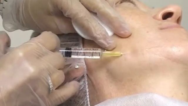 Мезотерапия смотреть онлайн