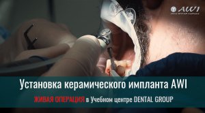 Живая операция: установка керамического импланта. Видео для медицины
