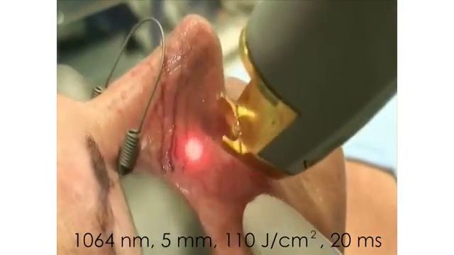 Coolglide Laser - Nose vein treatment смотреть онлайн