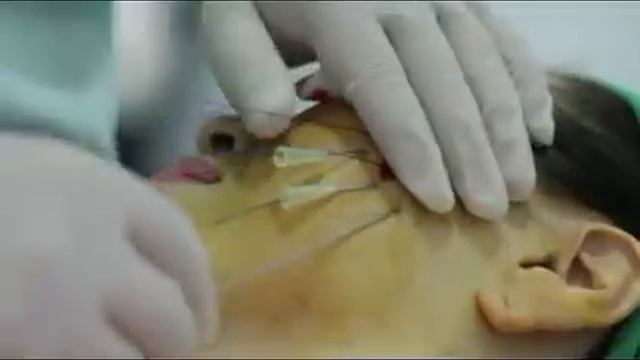 FACE Lifting with BB-Lock (PDO Cog Thread Lifting) : BB-Procedure смотреть онлайн