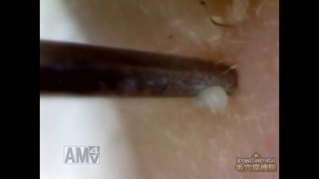 #10 Continuous Removal Of Blackheads Close Up - Squeezing Blackheads