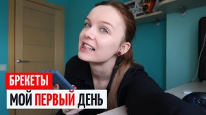 Первый День в Брекетах. Что есть в брекетах / Как чистить / Брекеты Цена 2022