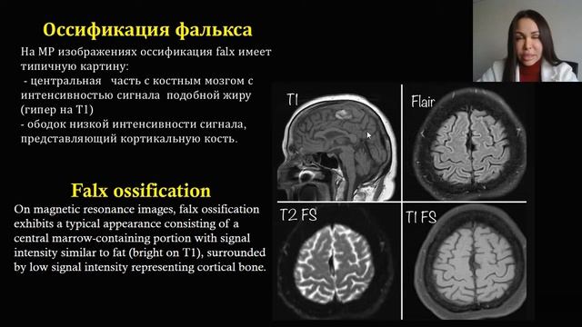 КАЛЬЦИФИКАЦИЯ ФАЛЬКСА | ОССИФИКАЦИЯ | МРТ | НАТАЛЬЯ МЕДВЕДЕВА | MOSCOW RADIOLOGY TEAM смотреть онлайн