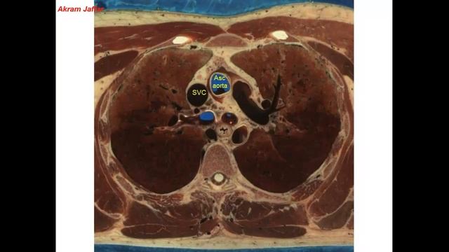Cross sectional and imaging anatomy of the thorax смотреть онлайн