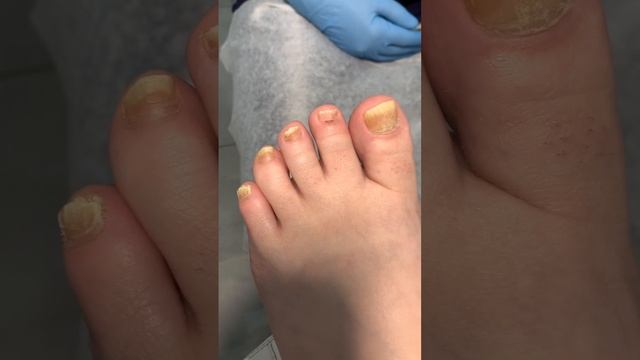 Ремонт ногтя - Подолог