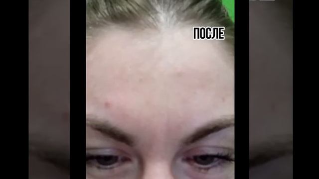ботокс на лоб смотреть онлайн
