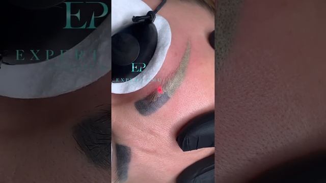 Удаляем синие брови лазером! смотреть онлайн