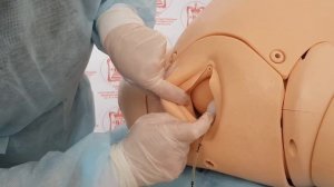 Алгоритм выполнения вакуум-экстракции плода