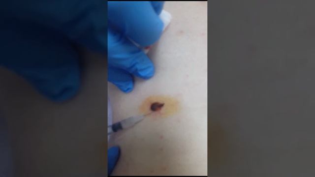 Родинка обезболивание смотреть онлайн