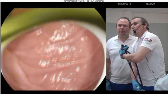 Визуализация большого дуоденального сосочка смотреть онлайн