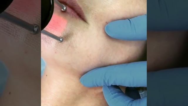 Поверхностный лазерный пилинг лица. Омоложение лица с помощью эрбиевого лазера. смотреть онлайн