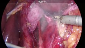 Лапароскопическая фундопликация по Ниссену