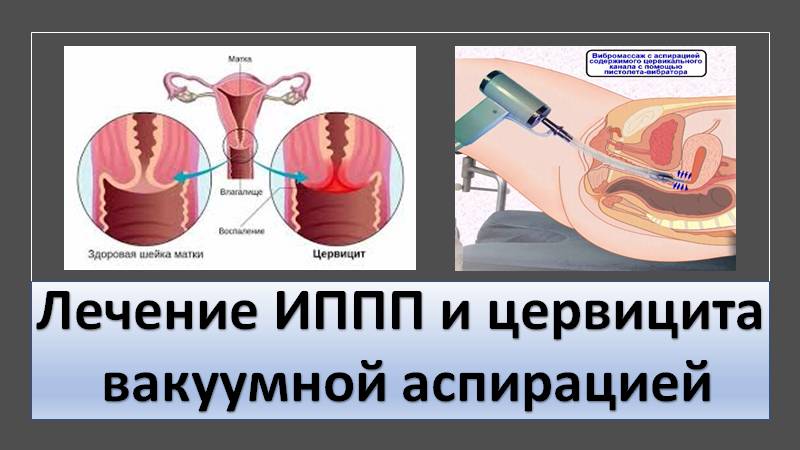 Лечение цервицита и ИППП вакуумной аспирацией смотреть онлайн