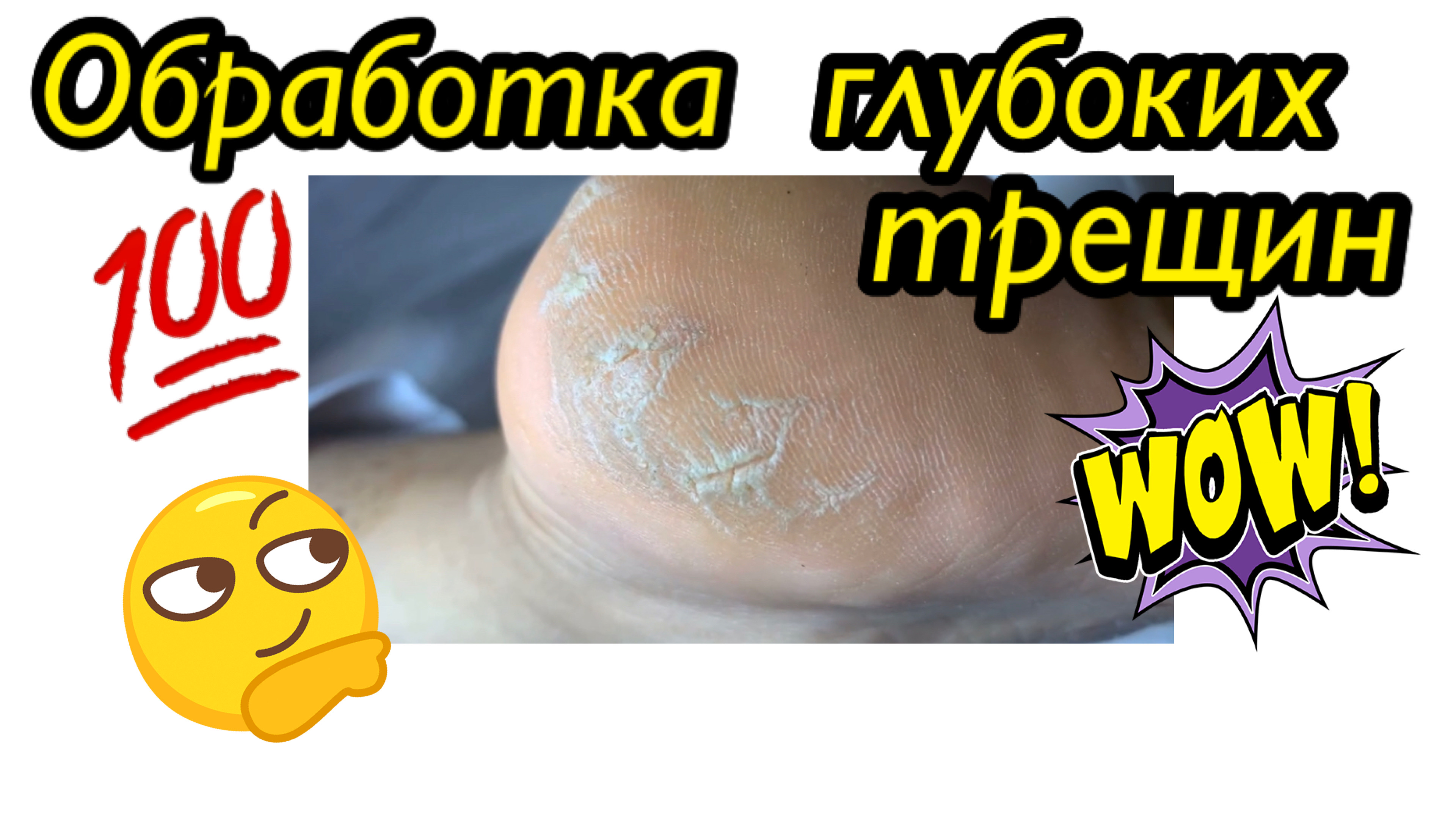 Глубокие трещины ??? • Зачистка??⚠️ смотреть онлайн