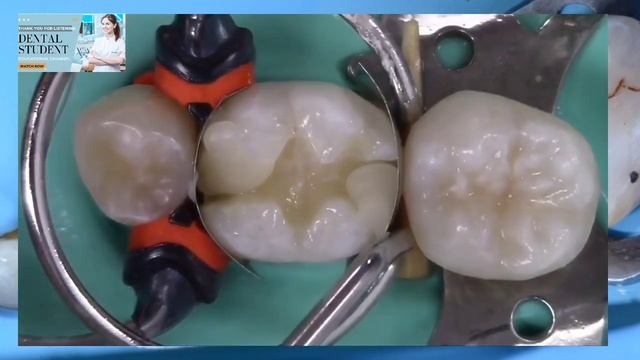 Class II Composite Restoration شرح عربي بسيط смотреть онлайн