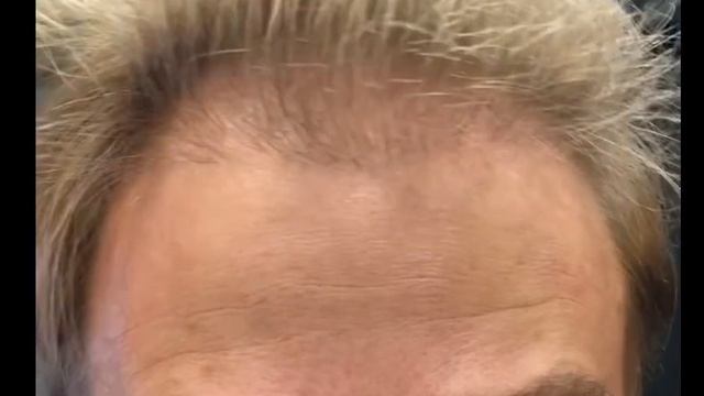 7 месяцев после пересадки волос смотреть онлайн