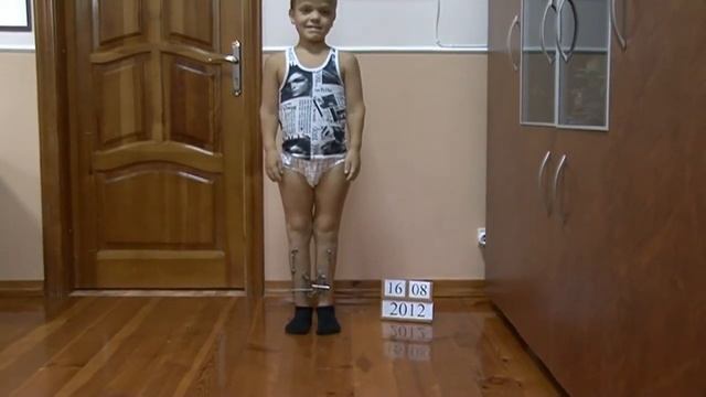 Ахондроплазия | Увеличение роста для детей | Доктор Веклич смотреть онлайн