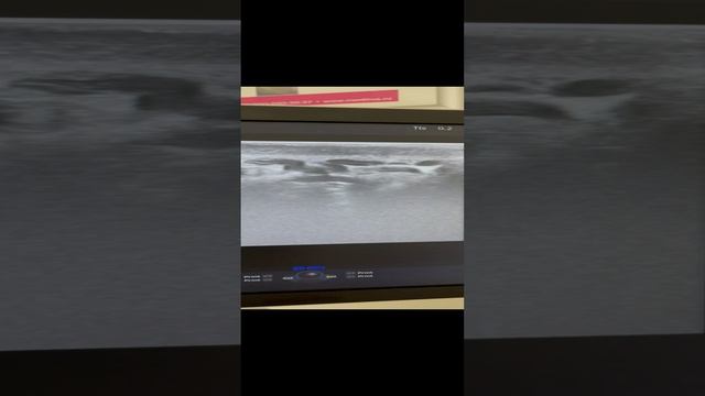 Варикоцеле у парня. Лечение варикоцеле. Узи при варикоцеле. Варикоз на мошонке. Урология. Флеболог смотреть онлайн