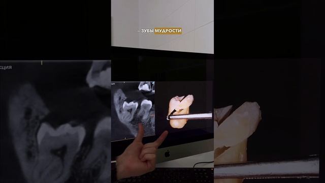 Зубы мудрости: когда лучше удалять? смотреть онлайн
