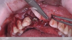 Немедленная имплантация. Пластика десны