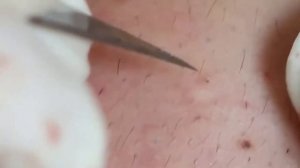 ? Выдавливание прыщей | Удаление и выдавливание прыщей и черных точек 2021 | Прыщи выдавливание #01