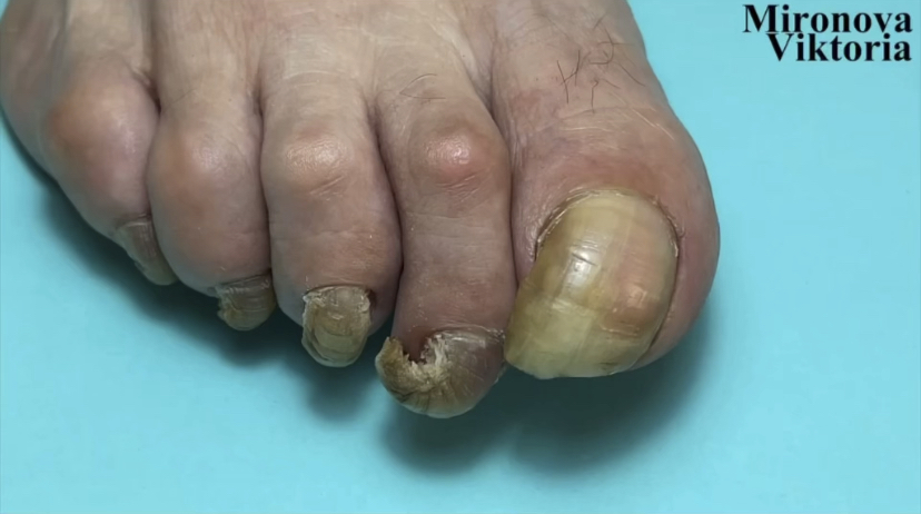 Онихогрифоз ногтей смотреть онлайн