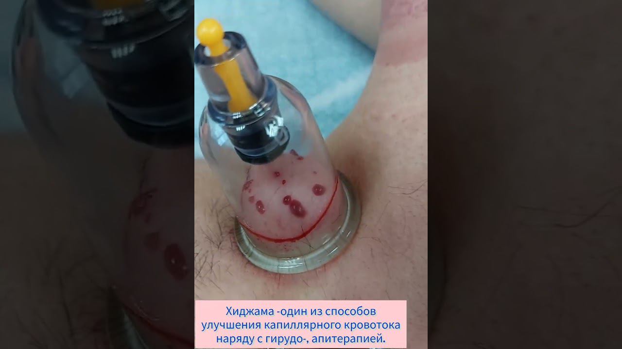 ХИДЖАМА смотреть онлайн