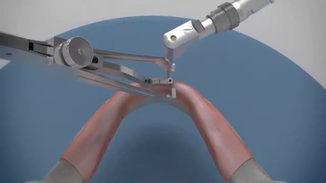 Cortex Dental Implants Easy2Fix #Моментальная установка условно-съемного протеза смотреть онлайн