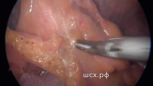 Латеральный дотуп при резекции прямой кишки смотреть онлайн