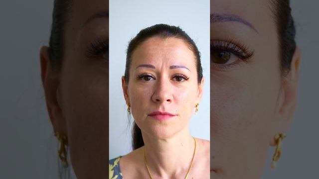 Варианты каркасного лифтинга для пациентов 35+ смотреть онлайн