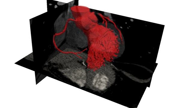 automatic segmentation of coronary arteries from CT-scan смотреть онлайн