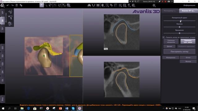 Диагностика анализ ВНЧС. Обучающее видео от Avantis3D смотреть онлайн