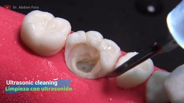 INCREIBLE reconstrucción de diente dañado por caries: Endodoncia en 4K смотреть онлайн