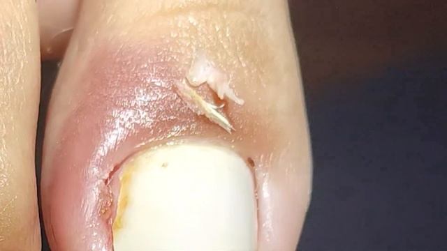 OVERGROWN INFECTED INGROWN TOENAIL REMOVAL (PODOLOGIA EM UNHA ENCRAVADA) смотреть онлайн