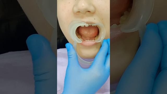 Самолигирующие брекеты до и после #стоматологалматы #брекетыалматы смотреть онлайн