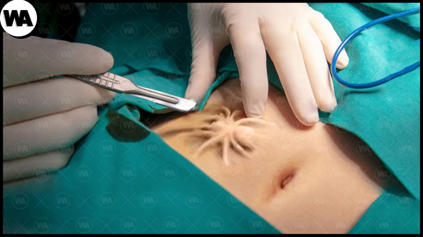 Мужчина Думал, что у Него Необычный Шрам, но Доктор Сказал Обратное. смотреть онлайн