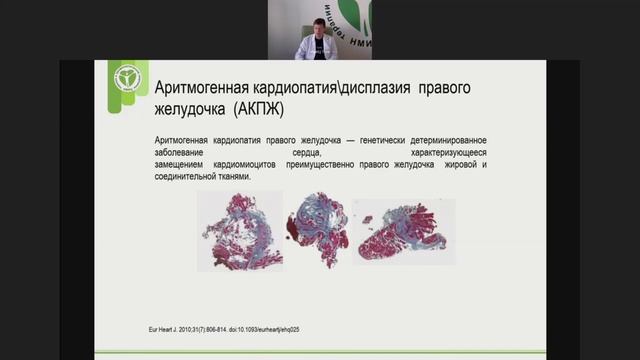 Кардиомиопатии. Профлактика внезапной сердечной смерти.