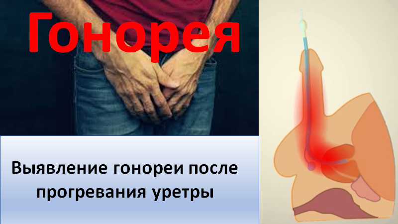 Выявление гонореи после прогревания уретры смотреть онлайн
