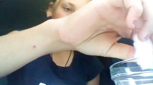 Как сделать синяк